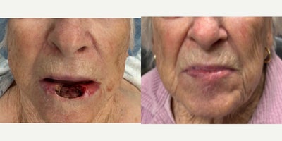 75 and up year old woman treated with Mohs Surgery - This lovely patient had an unfortunate skin cancer of the lower lip. After her Dermatologist removed the lesion she was left with a fairly large defect of the lip. We were able to quickly repair and reconstruct her lip and we are all so happy with how well she's been healing at 2 months out from surgery.