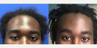 Man treated with Forehead Reduction - Man treated with Forehead Reduction