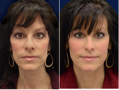 45-54 year old woman treated with Cheek Augmentation - Cheek augmentation with Juvederm Voluma