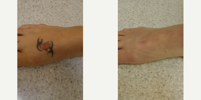 Woman treated with Tattoo Removal - Female patient treated with Laser Tattoo Removal to reduce the appearance of unwanted body art on top of foot.