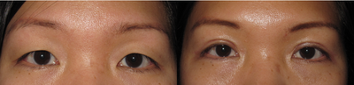 25-34 year old woman treated with Eyelid Surgery - Bilateral upper eyelid blepharoplasty