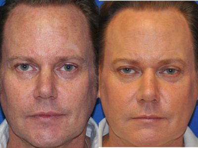 45-54 year old man treated with SmartXide - 48 year old man treated with SmartXide Laser Skin Resurfacing