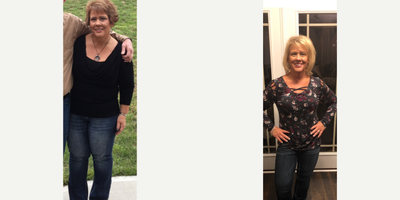 45-54 year old woman treated with Orbera Intragastric Balloon - 40lb weight loss with Orbera.