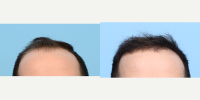 25-34 year old man treated with FUE Hair Transplant, Hair Transplant, Hair Loss Treatment, PRP for Hair Loss, PRP Injections - During this 31-year-old patient's FUE hair transplant, Dr. Wise used 3,050 grafts to restore his receding hairline and add density to the scalp overall. In addition, to fortify the follicles, he performed one treatment of PRP therapy.