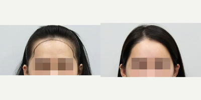 18-24 year old woman treated with Forehead Reduction - Forehead Reduction
