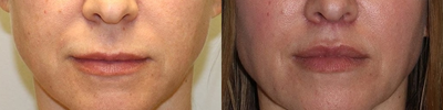Restylane - Many patients come to me requesting treatment to their lips. There are many treatments available including lip filler, laser treatments and surgical treatments such as the lip lift.Lip fillers such as restylane and juvederm are injections that can provide a nice fullness and volume to the lips. They are injected with a numbing agent to help minimize discomfort. These are some of the most common aesthetic procedures performed.