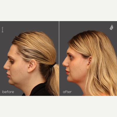 Submental Liposuction - 27 yo female who is 3 months out from submental liposuction performed in the office under local anesthetic