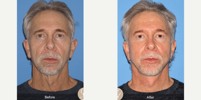 65-74 year old man treated with Facelift, Neck Lift - Man treated with Facelift, Neck Lift