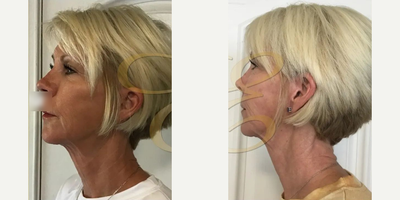 Woman treated with Skin Tightening - Woman treated with Skin Tightening
