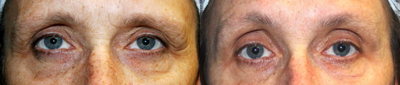 55-64 year old woman treated with ThermiSmooth - ThermiSmooth is a procedure for improving the appearance of aging skin through skin tightening via increased collagen production. It uses a unique hand piece, called a thermistor. The thermistor delivers targeted heating using temperature controlled RF energy to the surface of the skin. You can get ThermiSmooth as anti-aging solution on your forehead, eyes, cheeks, neck, and even mouth.