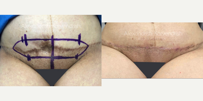 25-34 year old woman treated with Scar Removal - Scar removal in a patient with a previous tummy tuck