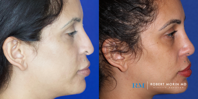 25-34 year old woman treated with Revision Rhinoplasty - This 32 year woman underwent a revision rhinoplasty using a diced cartilage and fascia graft in order to reconstruct her nasal dorsum. A silicone implant that had been placed by another surgeon was removed and rib cartilage was used in its place. The 1 year result demonstrates a beautiful nasal profile created entirely from the patient's own tissue.