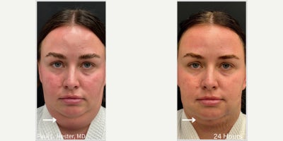 30 year old woman treated with FaceTite - 