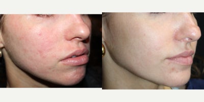 25-34 year old woman treated with Vbeam, and Medical Facials - 25-34 year old woman treated with Vbeam, and Medical Facials