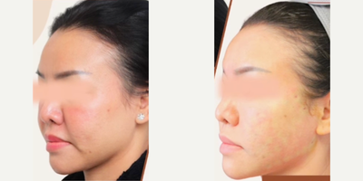 Woman treated with Thread Lift, Contour Thread Lift - Threadlift for the faceThreadlift is not a new procedure, it has been popular in Asia for many years. It gives patients the appearance of a facelift without downtime, incisions, and scars. Of course, it doesnt last as long as a facelift. From my experience, using absorbable threads, the effect lasts six months to a year and many patients come annually for maintenance.