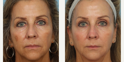 45-54 year old woman treated with Vivace - Patient received three Vivace treatments. Photos were taken seven months apart.