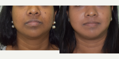 25-34 year old woman treated with Cosmelan - 27 year old female with hyperpigmented and uneven skin tone desired to get it corrected. Cosmelan peel done.