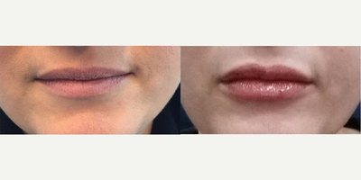 Woman treated with Lip Augmentation - Woman treated with Lip Augmentation