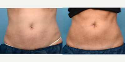 45-54 year old woman treated with CoolSculpting - One session of CoolSculpting at Wise Med Spa was all it took to give this patient the definition she was looking for in her abdomen. Three months post-treatment, she couldn't be happier with her slimmer appearance!