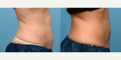 45-54 year old woman treated with Cryolipolysis - One session of CoolSculpting at Wise Med Spa was all it took to give this patient the definition she was looking for in her abdomen. Three months post-treatment, she couldn't be happier with her slimmer appearance!