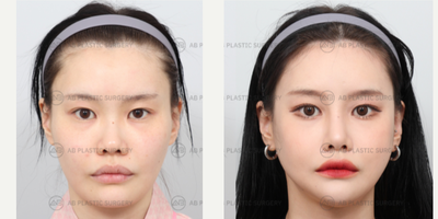 25-34 year old woman treated with Genioplasty, Jaw Reduction, V Line Surgery, Rhinoplasty, Cheekbone Reduction - Mandible Jaw Reduction, Genioplasty, Zygoma Reduction, Rhinoplasty (Nose Ridge+Nose Tip+Short Nose Correction+Weir Reduction+Donated Rib Cartilage (use at nose tip))