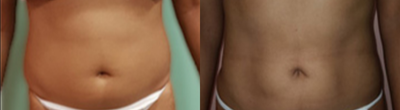 25-34 year old woman treated with Body-Jet - 28 years old female who underwent Water Jet / Body Jet Liposuction.