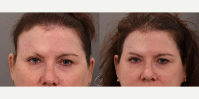 45-54 year old woman treated with Eyebrow Transplant - Mohs surgery and radiation left this patient with significant hair loss along the right temple and brow. Dr. Montague performed a follicular unit transplantation (FUT) procedure to take hair from the back of the scalp and move it to the affected areas. She is now 5 months post-op and seeing tremendous growth!