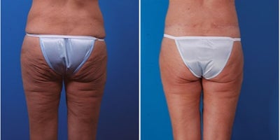 45-54 year old woman treated with Body Lift - Procedure: Lower body lift, inner thigh lift, buttock fat injection, liposuction of the abdomen, flanks, outer thighs, and knees.