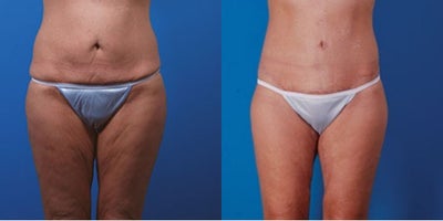45-54 year old woman treated with Body Lift - Procedure: Lower body lift, inner thigh lift, buttock fat injection, liposuction of the abdomen, flanks, outer thighs, and knees.