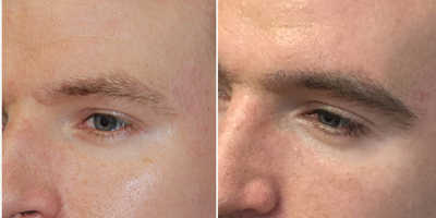 25-34 year old man treated with Eyebrow Transplant - This patient had a single FUT eyebrow transplant of 235 follicles to reinforce both eyebrows.