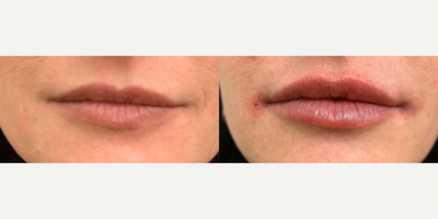Woman treated with Juvederm - Woman treated with Juvederm