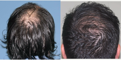 35-44 year old man treated with Hair Transplant - 7 mo post Neograft with incredible results.
