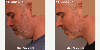 Man treated with Mini Neck Lift - Man treated with Mini Neck Lift