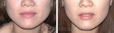 Jaw - 	Non-surgical Jaw Reduction