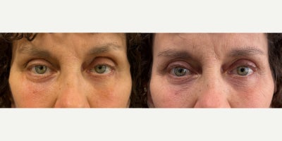 55-64 year old woman treated with Ptosis Surgery, Eyelid Surgery - 3 months after upper eyelid ptosis repair and blepharoplasty