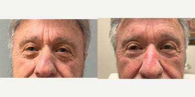 55-64 year old man treated with Chemical Peel, TCA Peel - This patient had a TCA chemical peel applied under the eyes to reduce wrinkles, creases, and pigmentation.