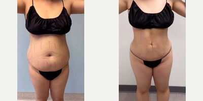 Woman treated with Lipo360BBL, Lipo360 - Cant get enough of this moms beautiful lipo360bbl4 WEEK POST OP TransformationShe is shy of a month, making amazing progress!You could see in the before video, the excess skin & fatty tissue and afterlipo360backfatliporenuvion j plasma to renuvion abdomen renuvion back