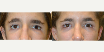 Treacher Collins lower eyelid reconstruction. - 19 year old female, with Treachers-Collins syndrome, underwent complex lower eyelid reconstruction with lower eyelid retraction surgery with canthoplasty.