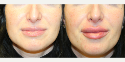 35-44 year old woman treated with Botox, RHA Collection Fillers - Botox and Lip Filler
