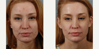 25-34 year old woman treated with Isolaz - Isolaz