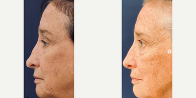 Woman treated with Revision Rhinoplasty - Our patient suffered from nasal collapse and deformities of her nasal tip after a botched rhinoplasty. We did a major revision rhinoplasty to restore her breathing and bring her nose closer to her original nose. Swipe to see a cast she had of her original nose.