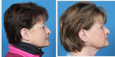 55-64 year old woman treated with Eyelid Surgery - Patient had a blepharoplasty (removal of excess upper eyelid skin) of both eyes.