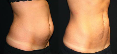 35-44 year old woman treated with UltraShape Power - The UltraShape Power device works by emitting waves of focused pulsed ultrasonic energy that converge where patients want to target stubborn fat. The device rapidly changes pressure waves causing targeted fat cells to rupture, releasing trigclycerides that are processed by the liver and eliminated naturally.