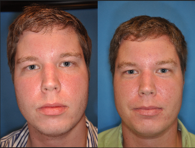 Scar Removal - Twenty-six year-old struck by bottle in forehead with subsequent repair performed at outside facility. Nine months after his initial repair, he noted poor contour, persistent redness and visibility of scar. He underwent a primary excision with closure and no further treatment. Post-operative photos nine months after repair demonstrate significant improvement in contour and decreased redness and visibility.