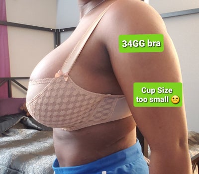 First Set of Large Implants November 2020 - Review - RealSelf