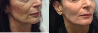 55-64 year old woman treated with fractionated  CO2 Laser facial ablation - Age spots and fine lines