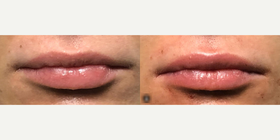 Woman treated with Lip Fillers - Woman treated with Lip Fillers