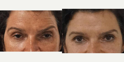 Woman treated with Fractional Laser - Peri-orbital rejuvenation: non-surgical approach. That's the power of fractional lasers (and some filler of course)