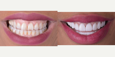 35-44 year old woman treated with Smile Makeover, Da Vinci Veneers, Lumineers - This patient improve her smile getting Veneers, now she looks more confidence and secure.Enjoy your new Smile!!!
