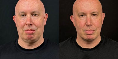 45 year old man treated with Endolift - Complaining of double chin, loss of jawline definition, widening of the lower face, continuation of the face into the neck with no definition.